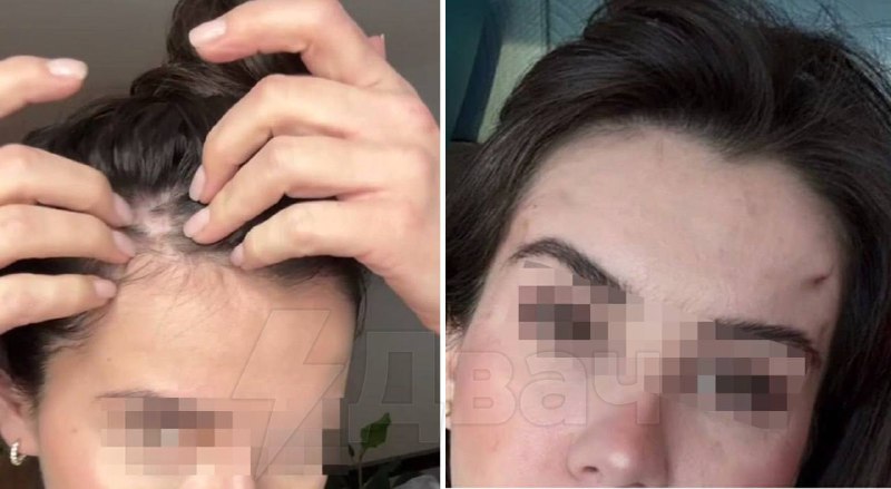 طالب جراح في إحدى عيادات التجميل الراقية في موسكو الفتاة بإظهار ثدييها…