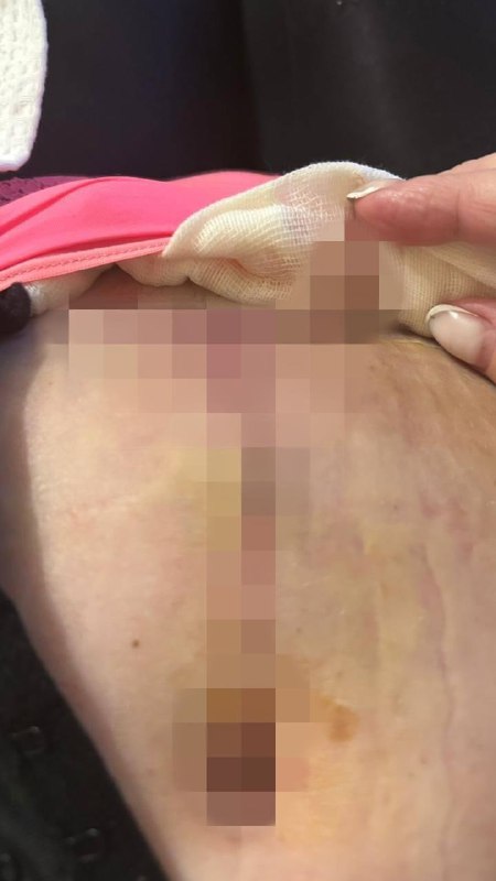 نسي جراحو التجميل ضمادة داخل المريضة – ولهذا السبب بدأت المرأة…