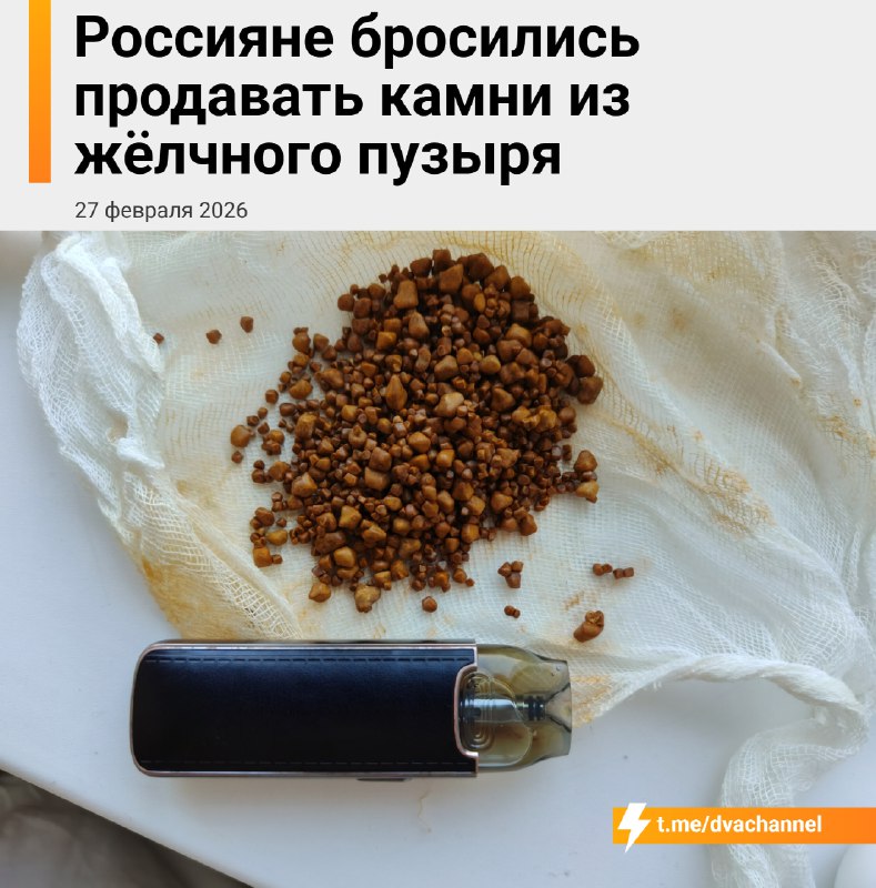 بدأ الروس في بيع حصواتهم على نطاق واسع. يأخذ المرضى…
