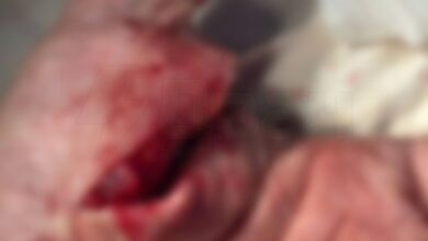 بالإضافة إلى فوبيا: رجل جرح يده بشدة أثناء محاولته فتح الأطعمة المعلبة…