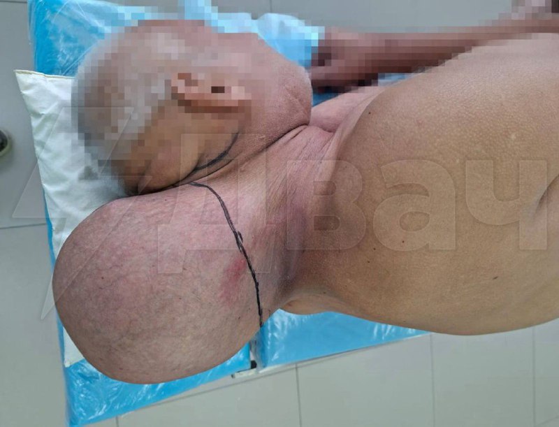 رجل يبلغ من العمر 65 عاما نما له ورم بحجم مرعب – تجاهل الورم لمدة 16 عاما..