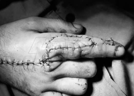 خدش إصبعه بسلك وكاد أن يفقده: كان أحد سكان منطقة موسكو يجمع…