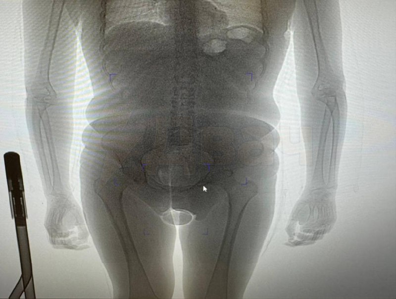 حاول ساعي مخدرات تهريب الكوكايين في واقيين ذكريين – أحدهما داخل…