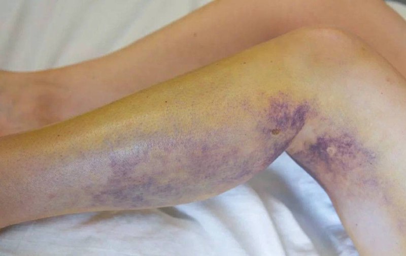 موجة من لدغات الأفعى اجتاحت موسكو ومنطقة موسكو: ضحايا غير متوقعين…